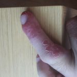 Środkowy palec zakażony Staphylococcus aureus
